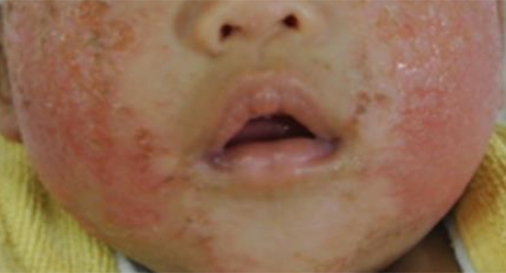 โรคผื่นภูมิแพ้ผิวหนัง (Atopic Dermatitis) 
